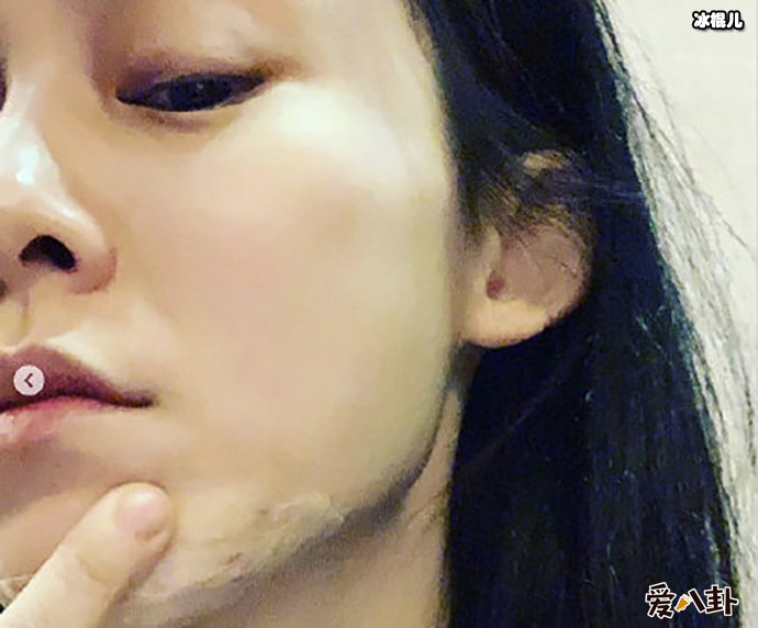 【QY球友会】范玮琪发生了什么下巴缝15针？为何其那么遭网友嫌弃？